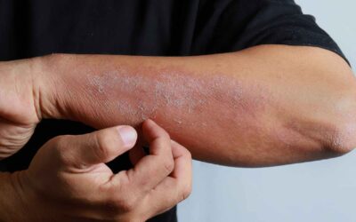 Monsoon Allergies – Managing Skin Irritations