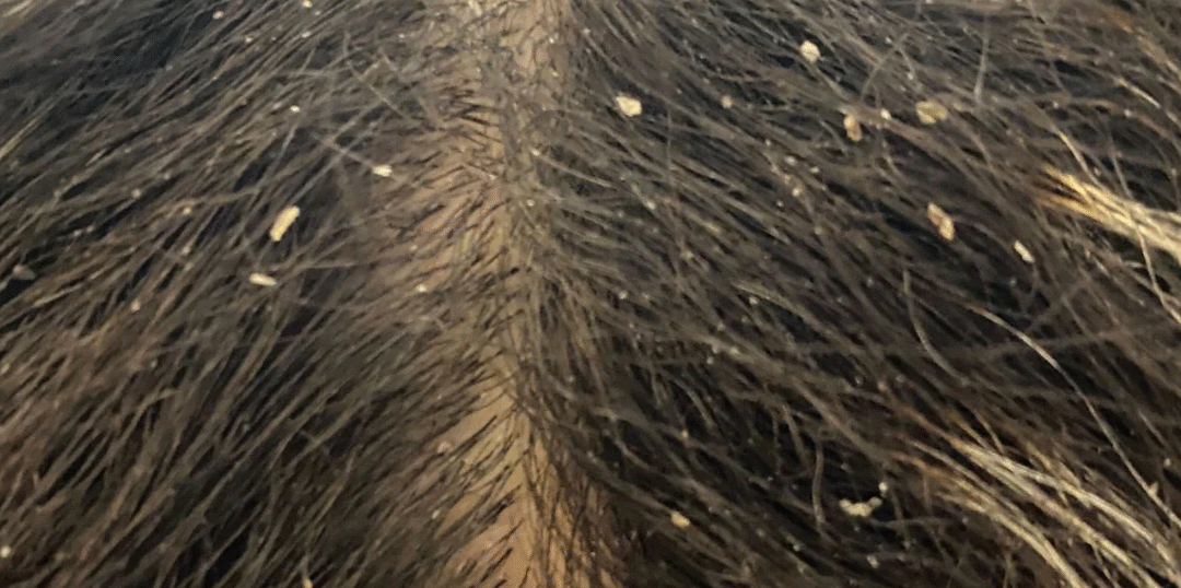 Fungal dandruff