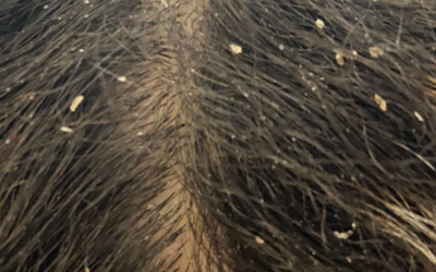 Scalp Health in Humid Weather: Don’t Ignore the Roots!