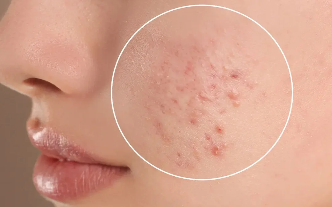 Understanding Acne – Causes, Types & Myths