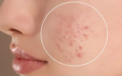 Understanding Acne – Causes, Types & Myths