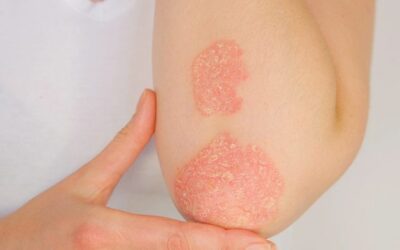 Understanding and Managing Acne, Eczema, and Psoriasis Effectively