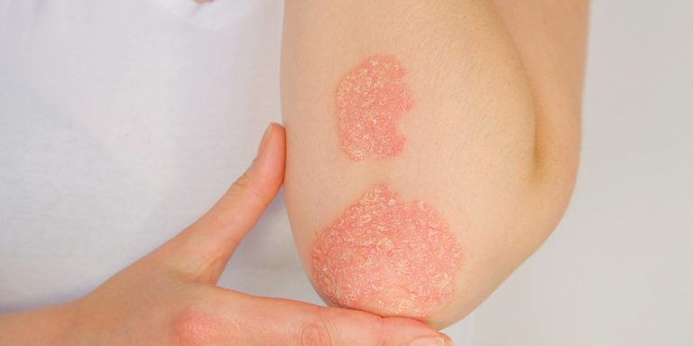 Understanding and Managing Acne, Eczema, and Psoriasis Effectively