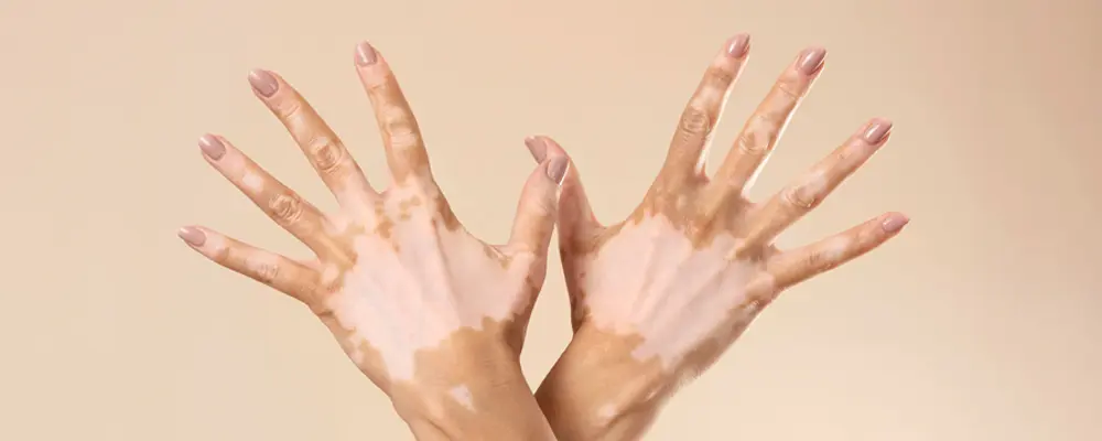 vitiligo-hereditary